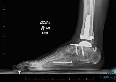 An x-ray of a person 's foot with a prosthetic ankle.