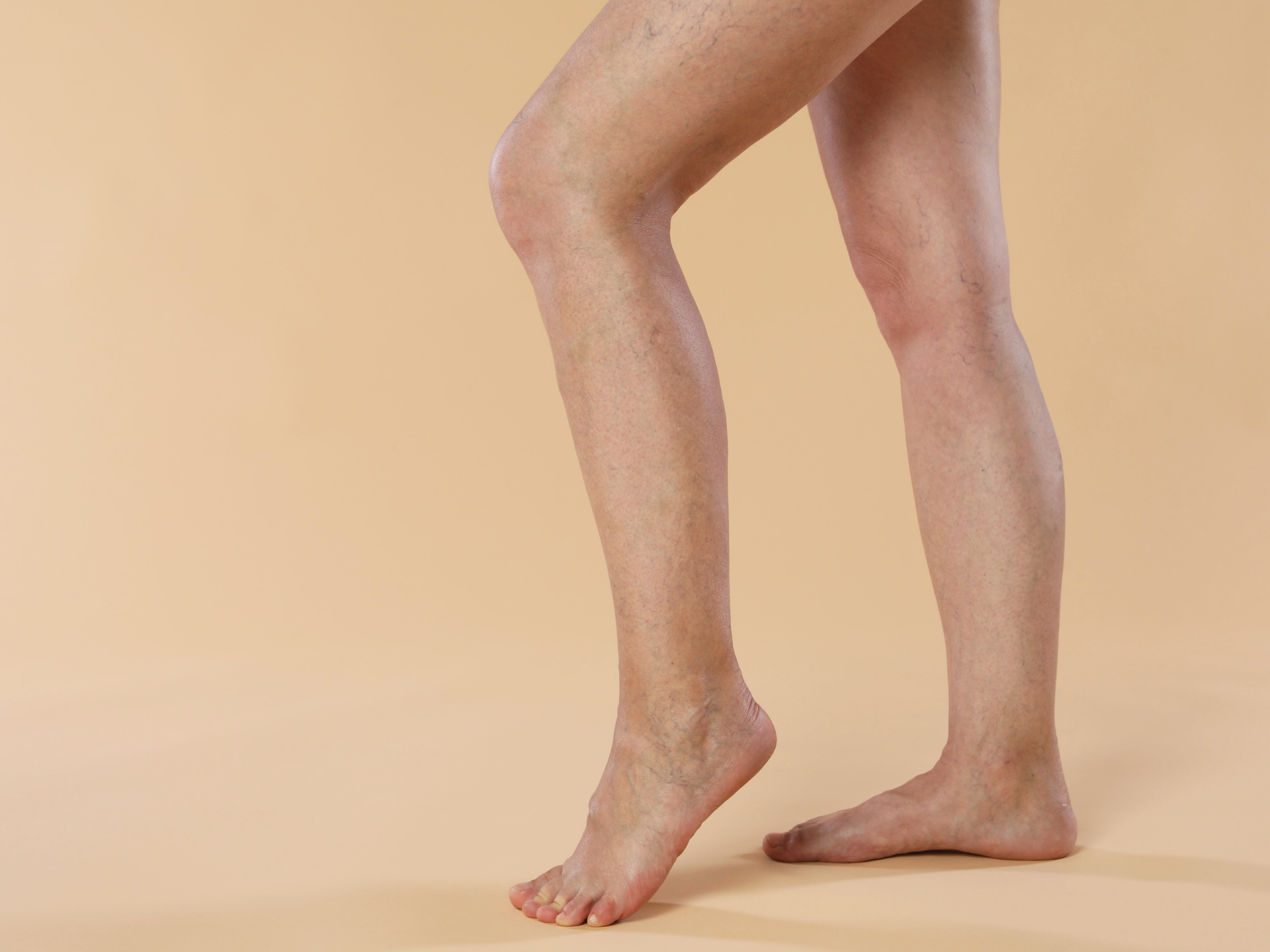 Rosacée / Varicosités –Petite zone