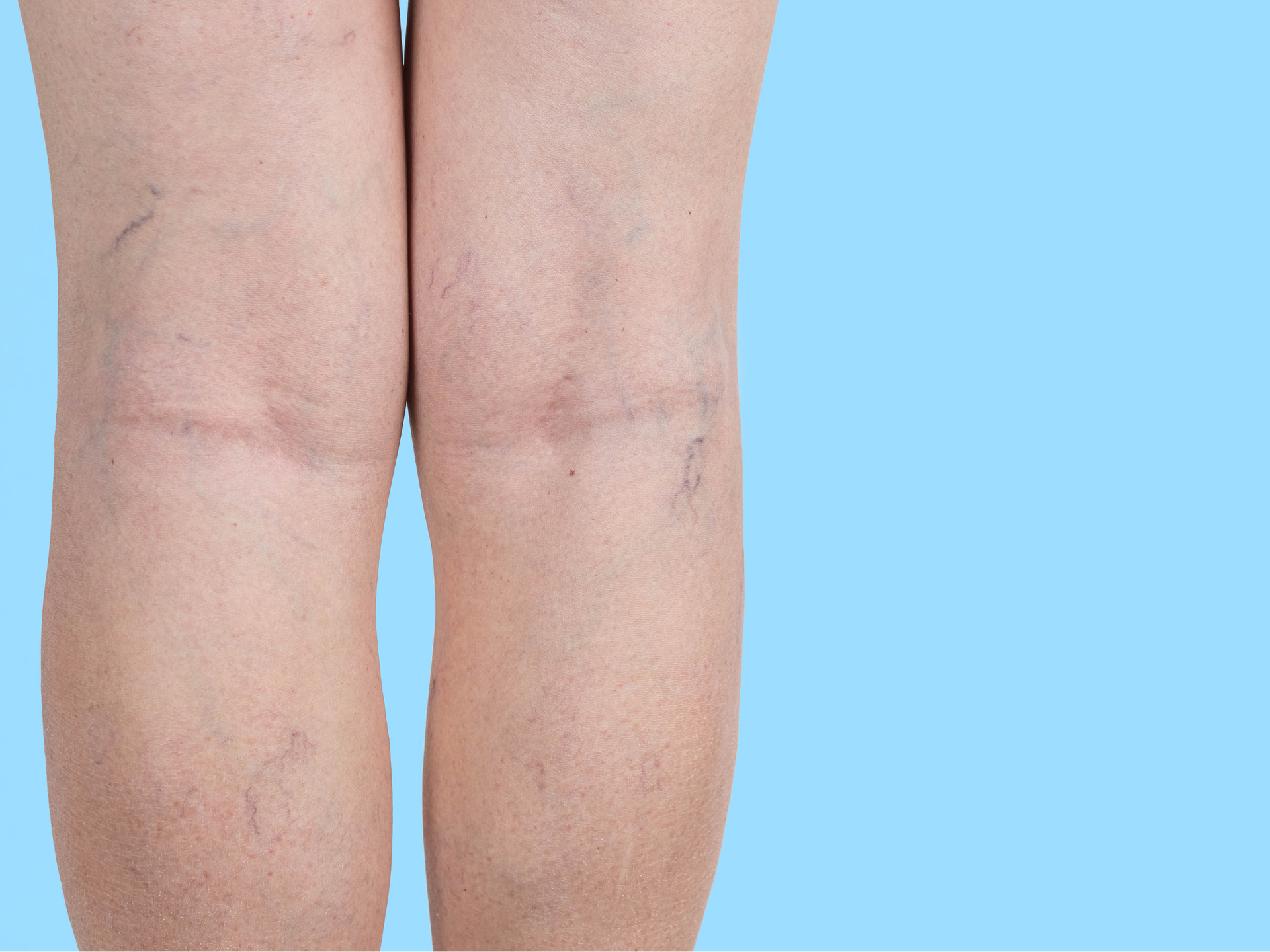 Varices jambes