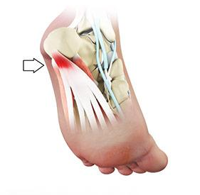 Plantar Fasciitis - Causes, Symptoms and Treatment