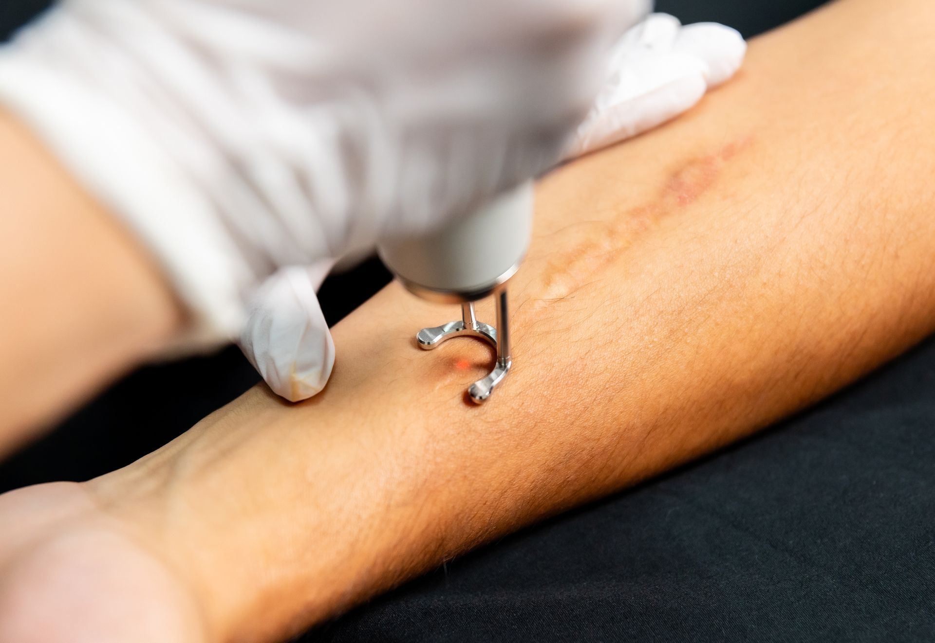 A gloved hand uses a medical device on a scar on an arm.