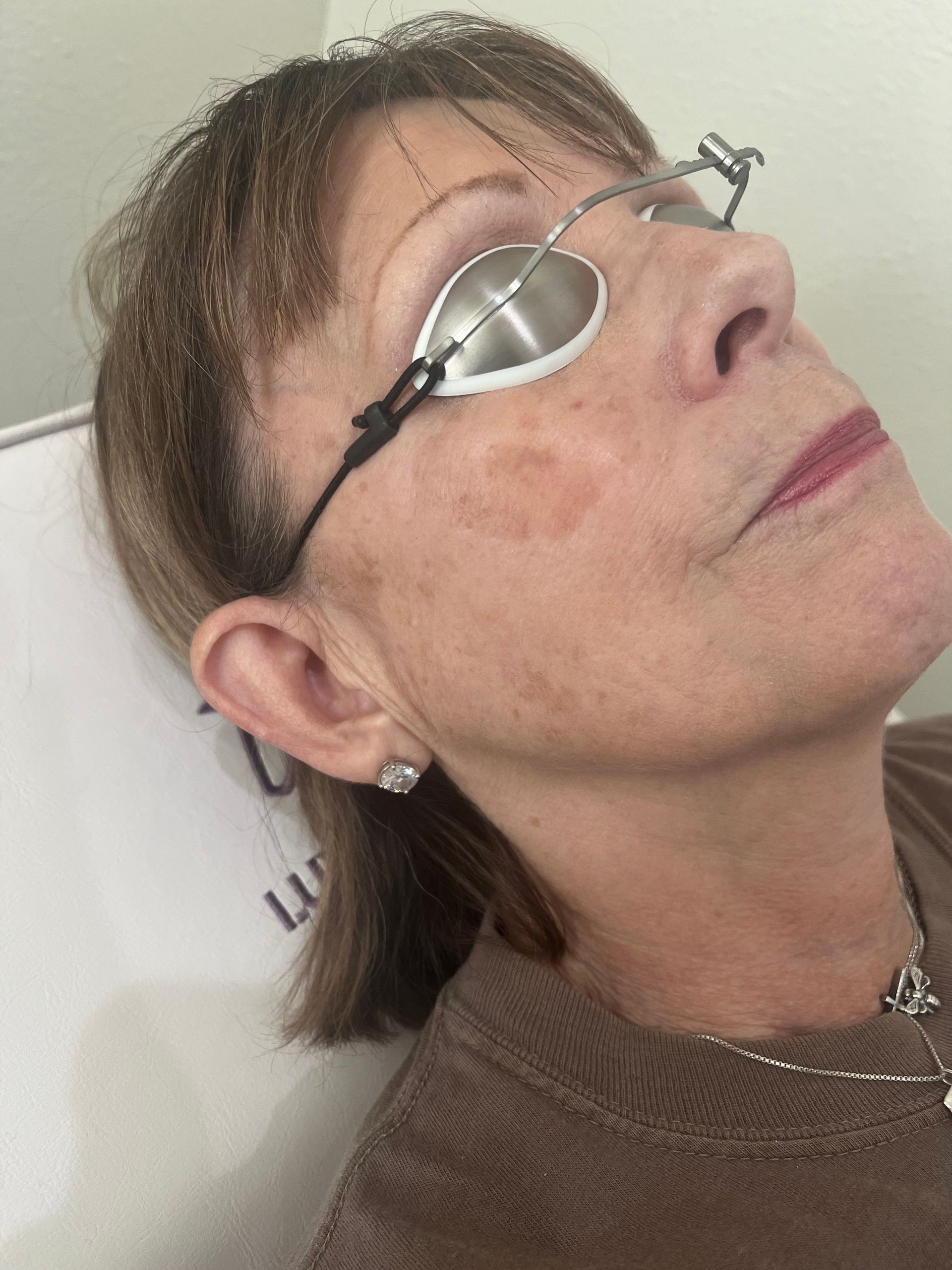 A person using a laser device on a patient's arm. Wearing protective eyewear in a medical setting.