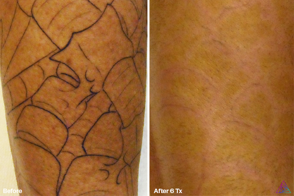 Leg before and after 6 laser tattoo removal treatments. Dark outline of tattoo fades.