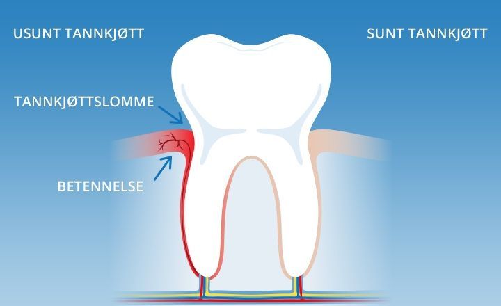 Gingivitt - Lillsestrøm tannlege 