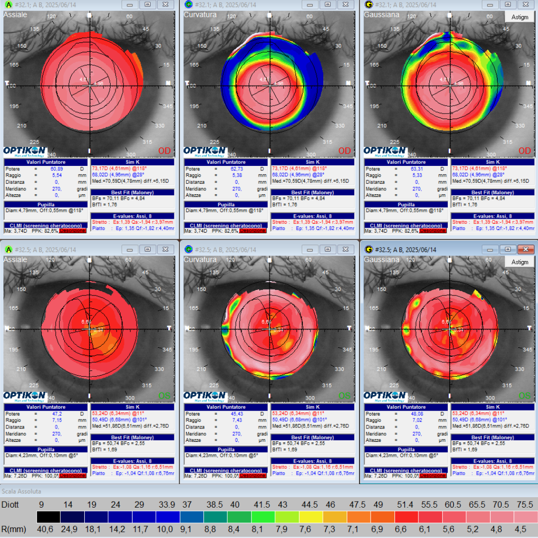 Topografia corneale per applicazione lenti a contatto