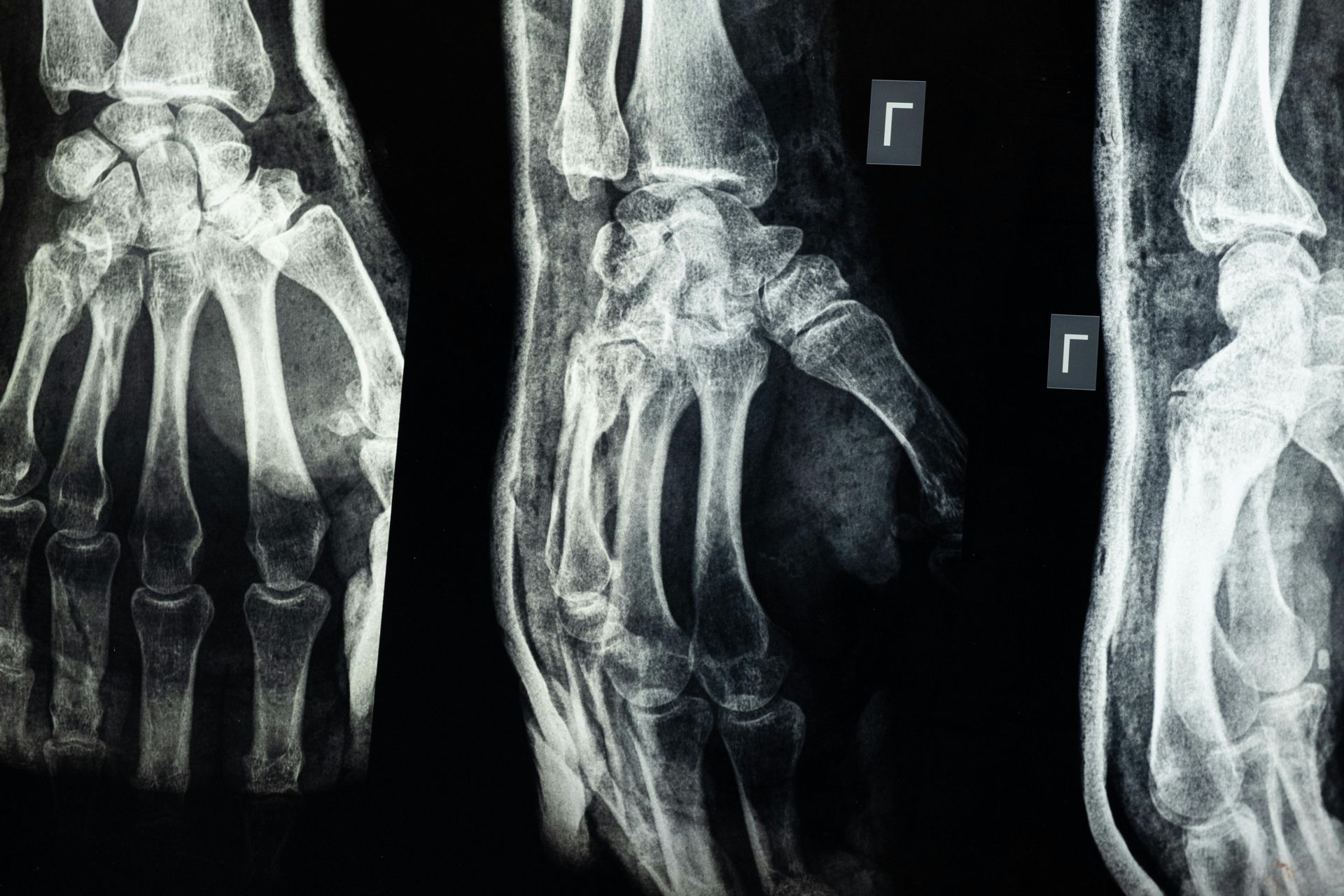 A black and white x-ray of a hand , wrist and foot.