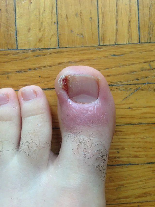 inizio cura unghia incarnita