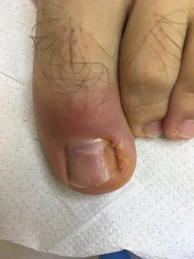 cura unghia incarnita