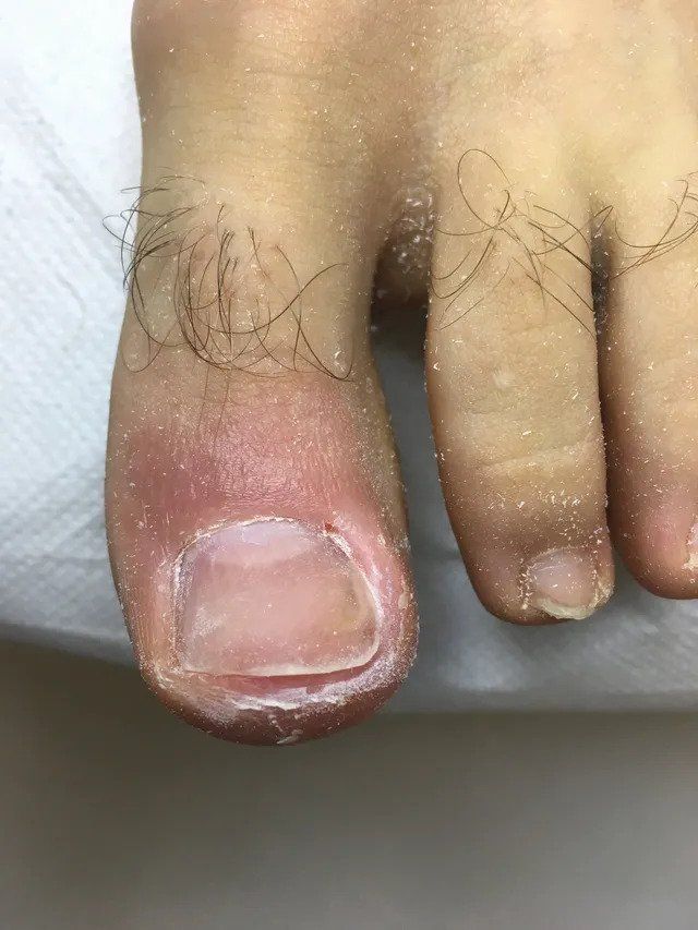 fine cura unghia incarnita