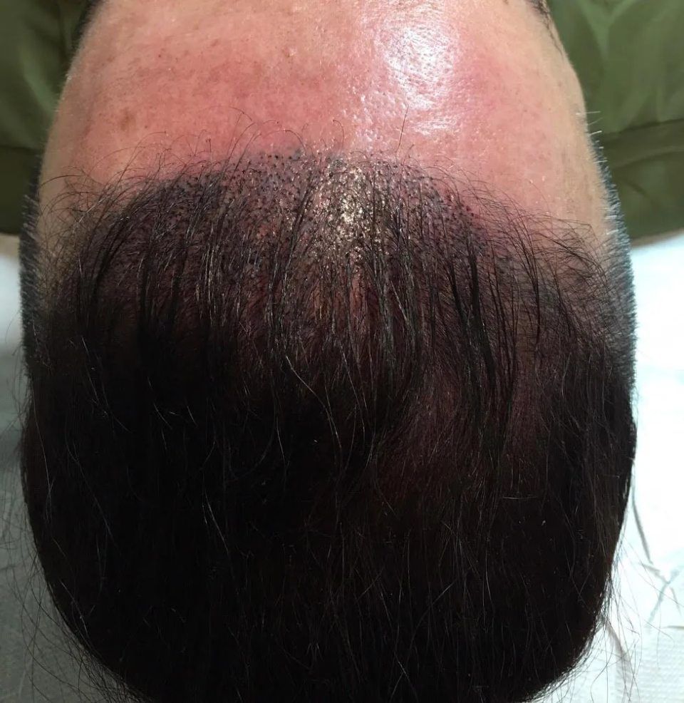 Capelli dopo trattamento di tricopigmentazione