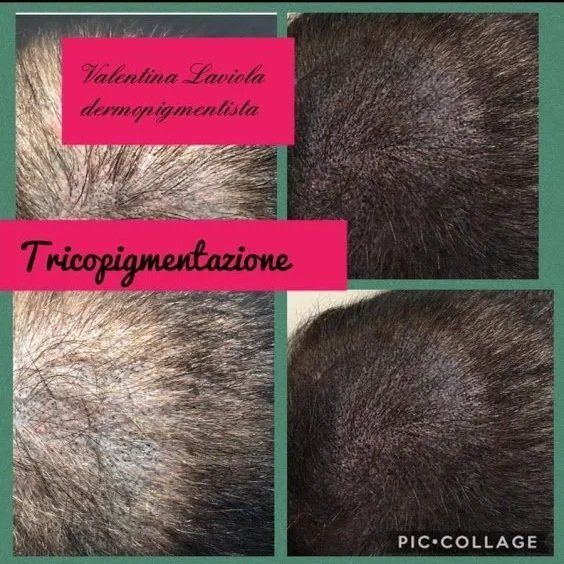 Capelli dopo trattamento di tricopigmentazione