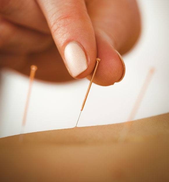 Hand inserting acupuncture needle into skin; other needles in background.
