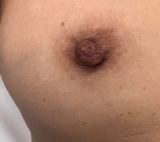 What to Know About Nipple Discharge