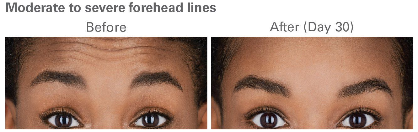 Botox Before and After 1