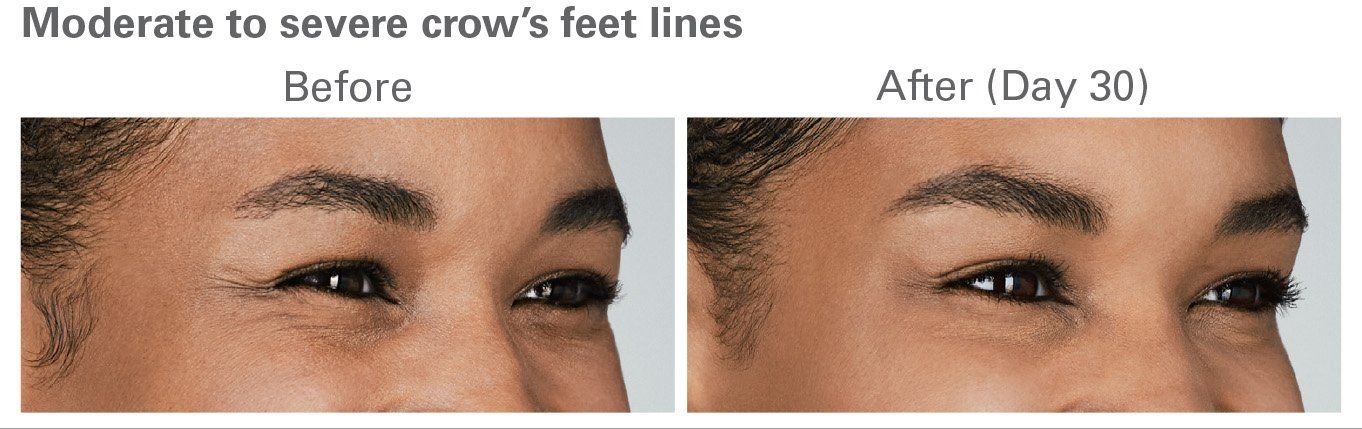 Botox Before and After 2