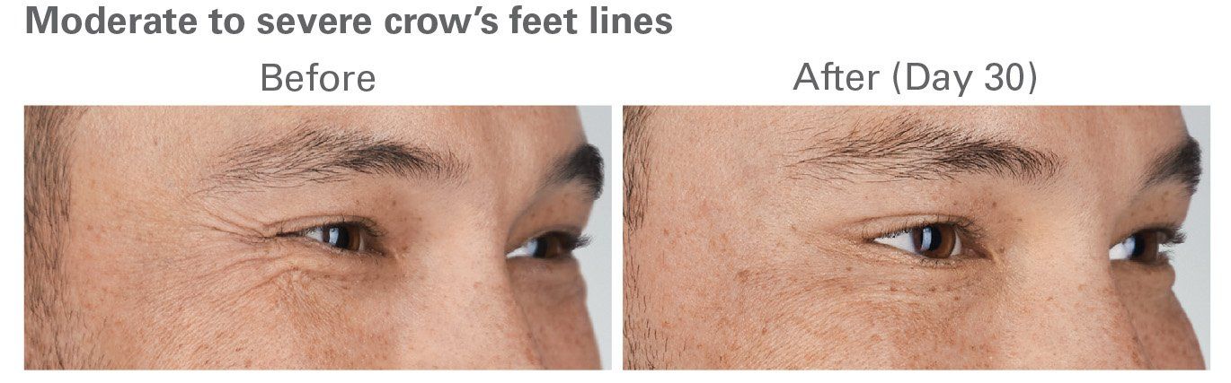 Botox Before and After 3