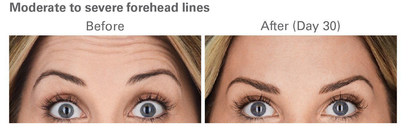 Botox Before and After 4
