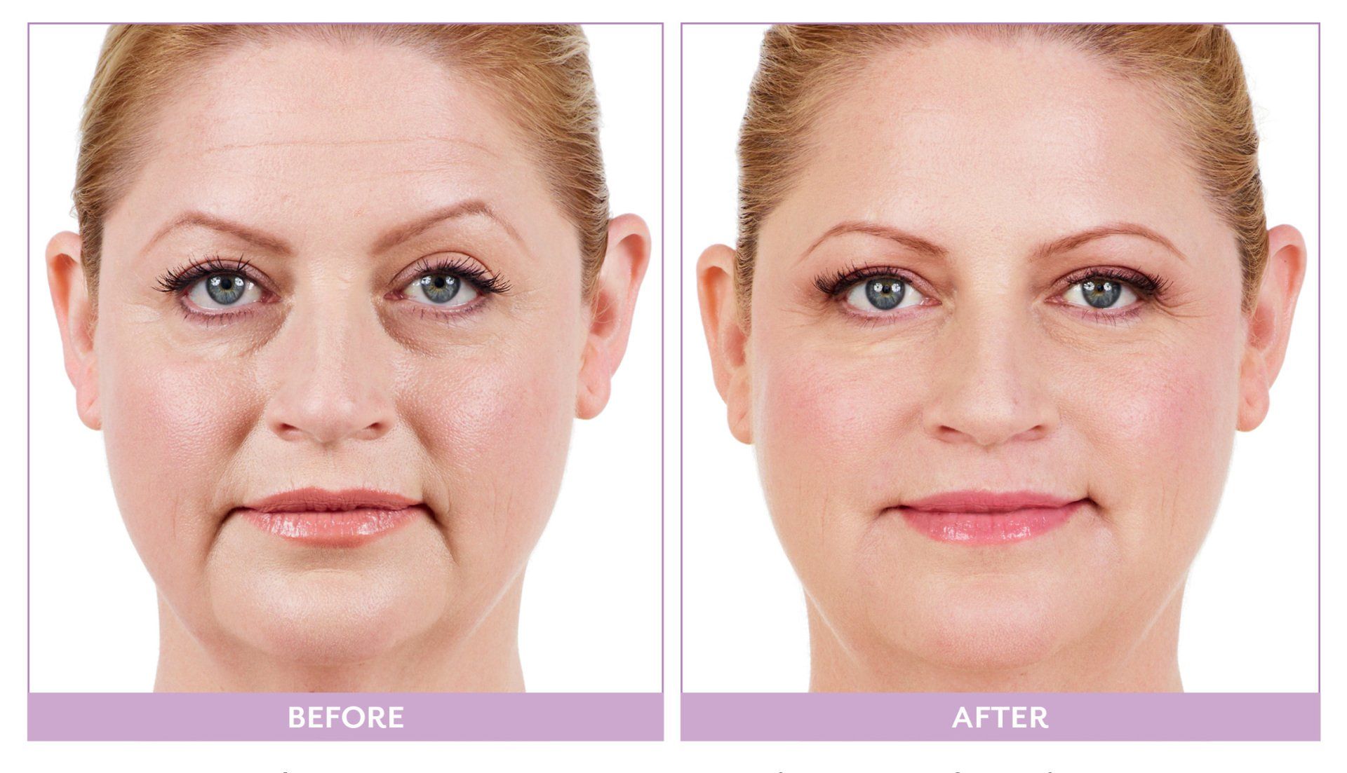 Juvederm Facial Fillers Before and After 2
