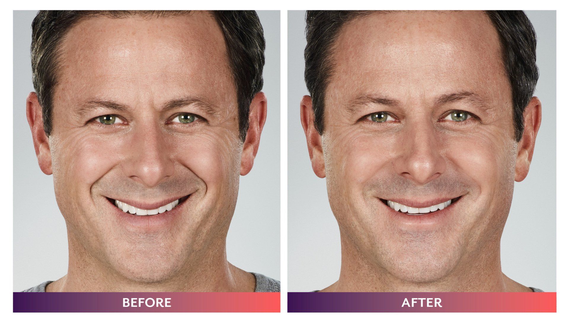 Juvederm Facial Fillers Before and After