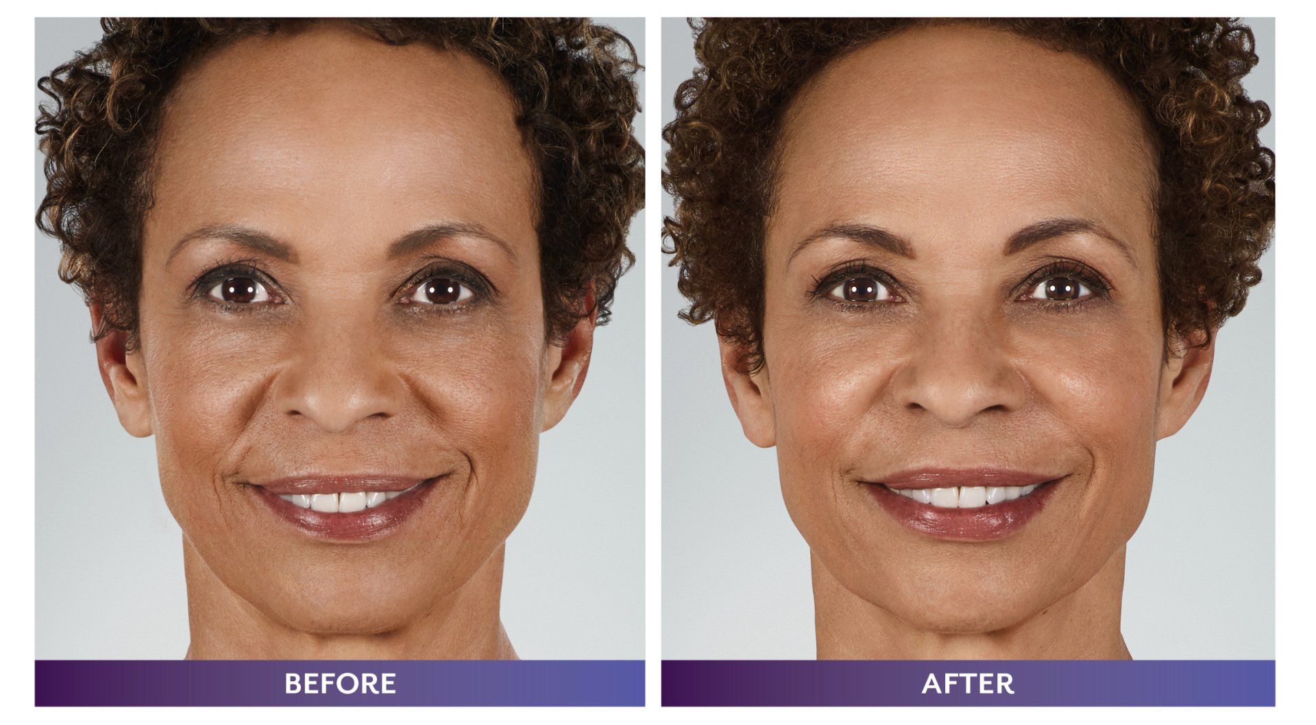 Facial Filler 2