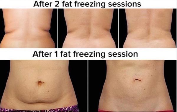 After Fat Freezing Session