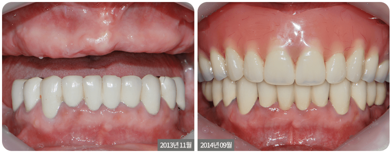 Implant Denture