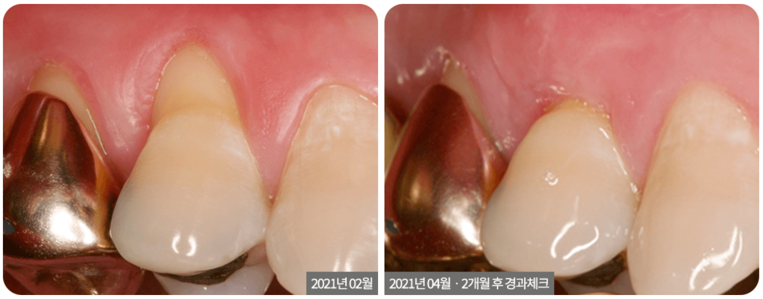 Gum Grafting (Root Coverage Surgery)