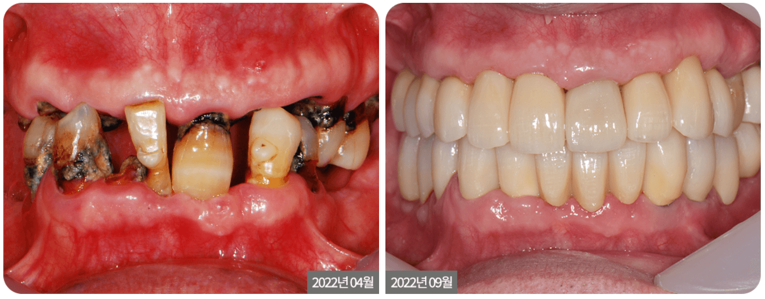 Full Mouth Implant