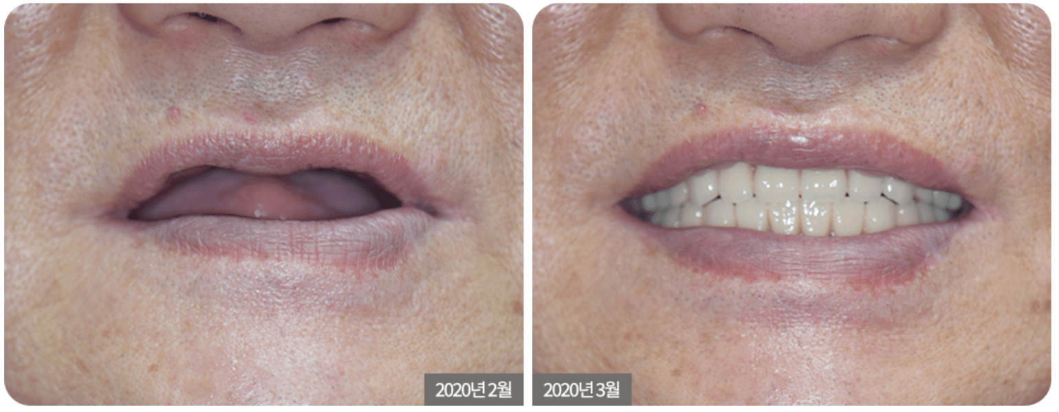 Full Mouth Implant
