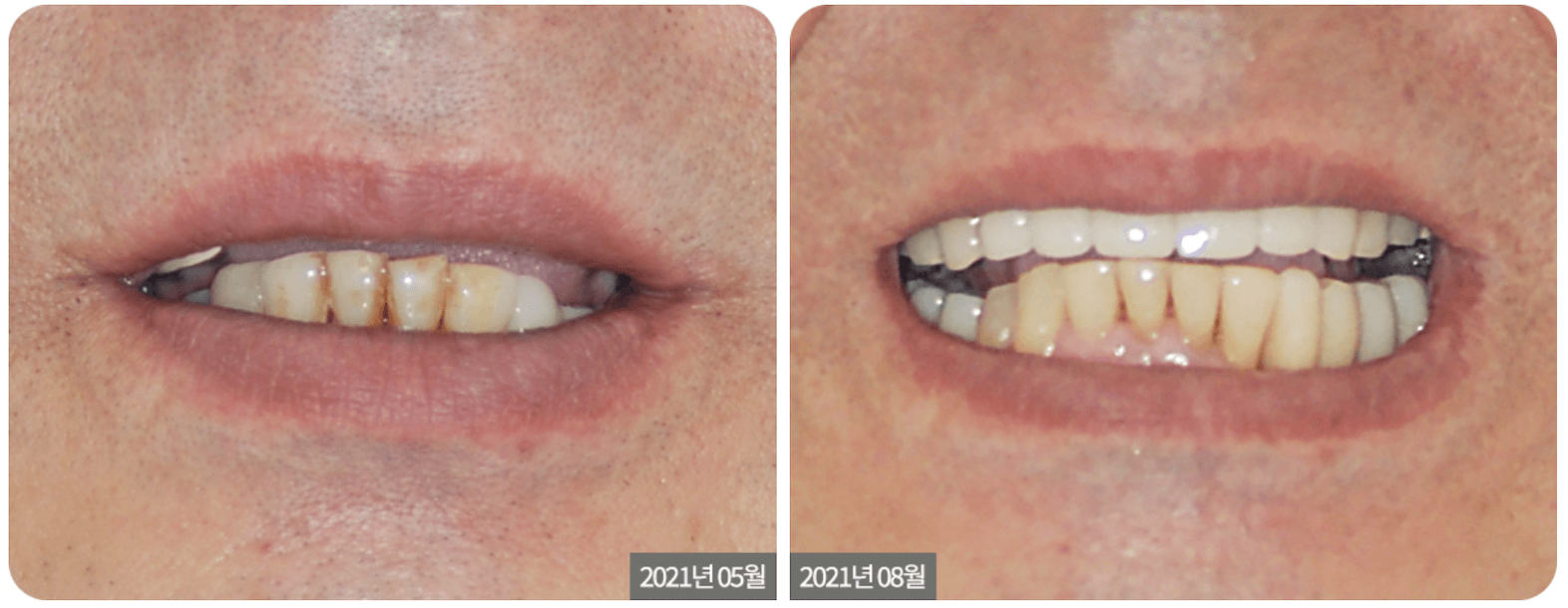 Anterior Dental Implant