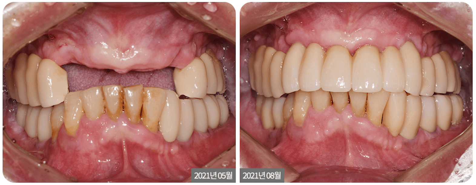 Anterior Dental Implant