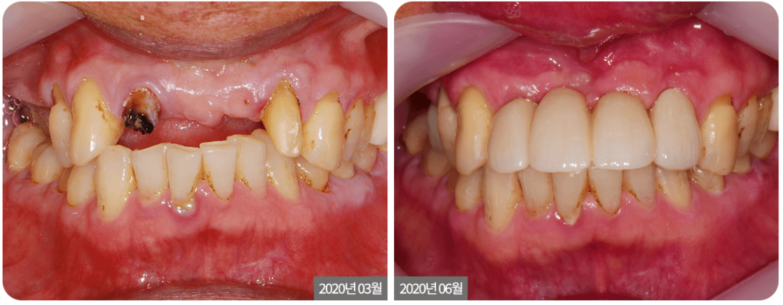Anterior Dental Implant