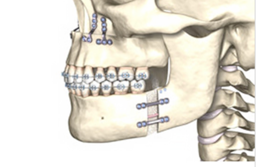 Double Jaw Surgery