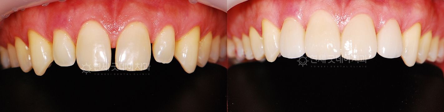 Before and after comparison of teeth. The 