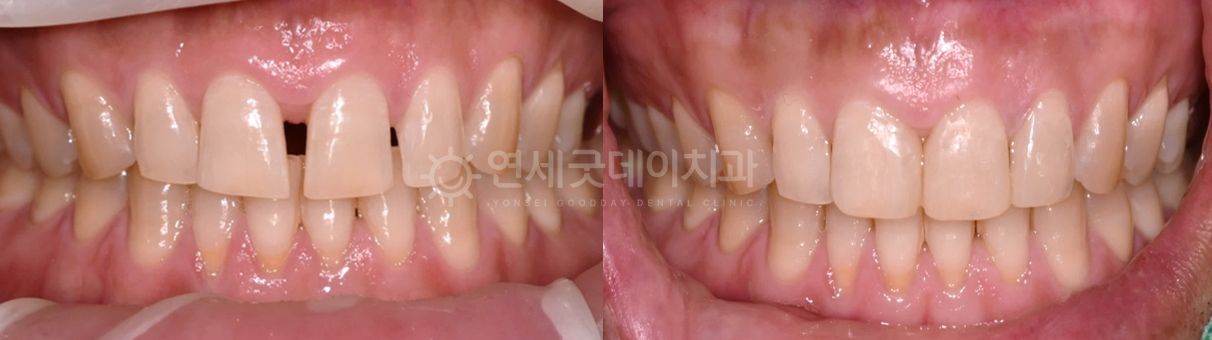 Before and after comparison of teeth. The 