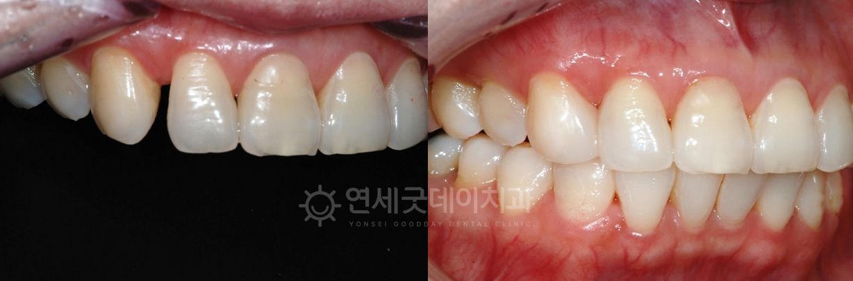 Before and after comparison of teeth. The 
