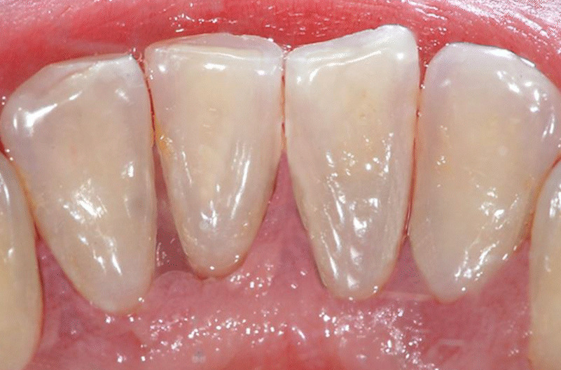 Close-up of a person's upper front teeth. They are white, and the gums are pink.