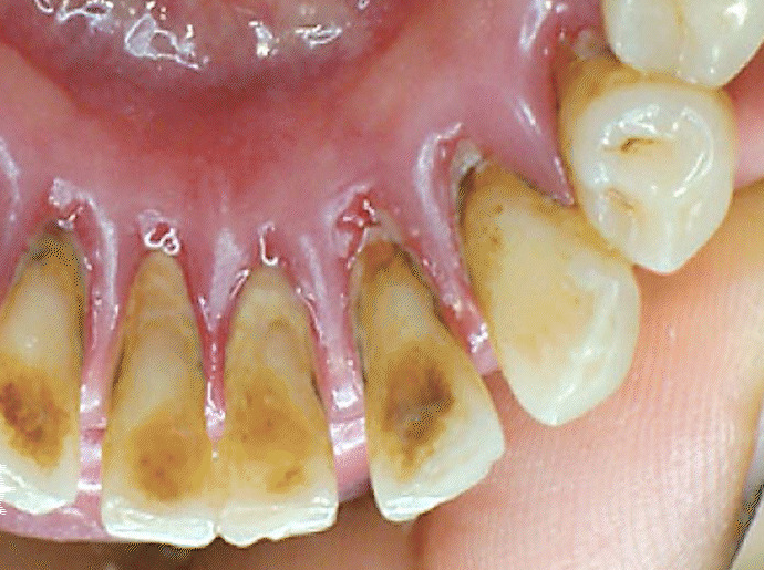 Close-up of a person's upper teeth with significant brown staining and discoloration, likely from poor oral hygiene.