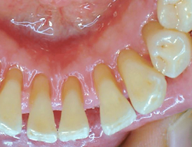 Close-up of a person's lower teeth. The teeth are slightly yellowed, and the gums are visible.