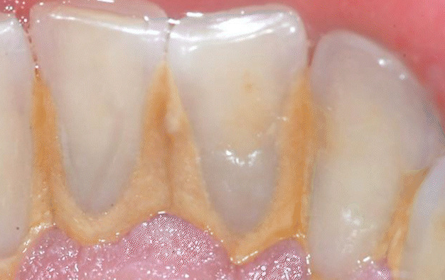 Close-up of teeth with visible yellowish tartar buildup along the gumline. Pink gums are also visible.