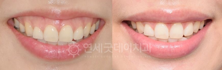 Before and after comparison of teeth. The 