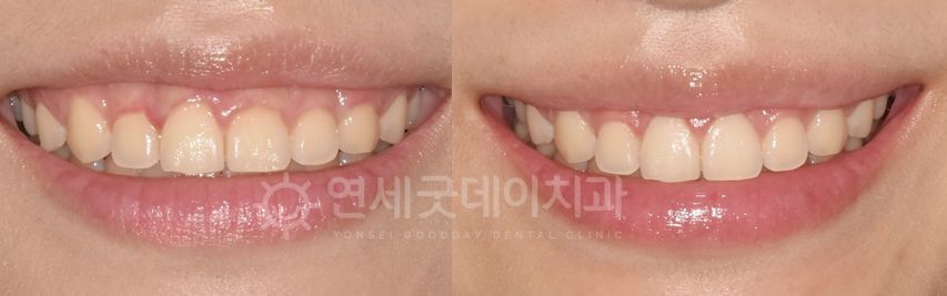 Before and after comparison of teeth. The 