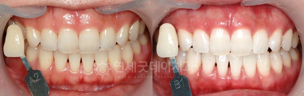 Before and after comparison of teeth. The 