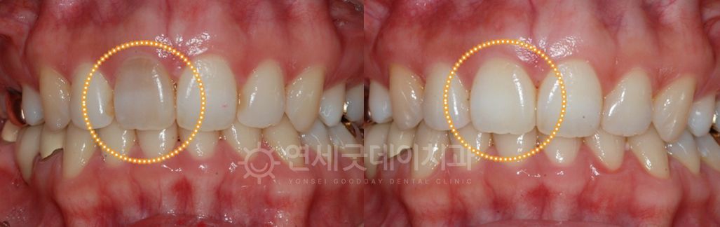 Before and after comparison of teeth. The 