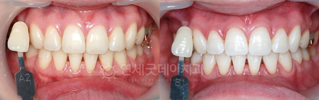 Before and after comparison of teeth. The 