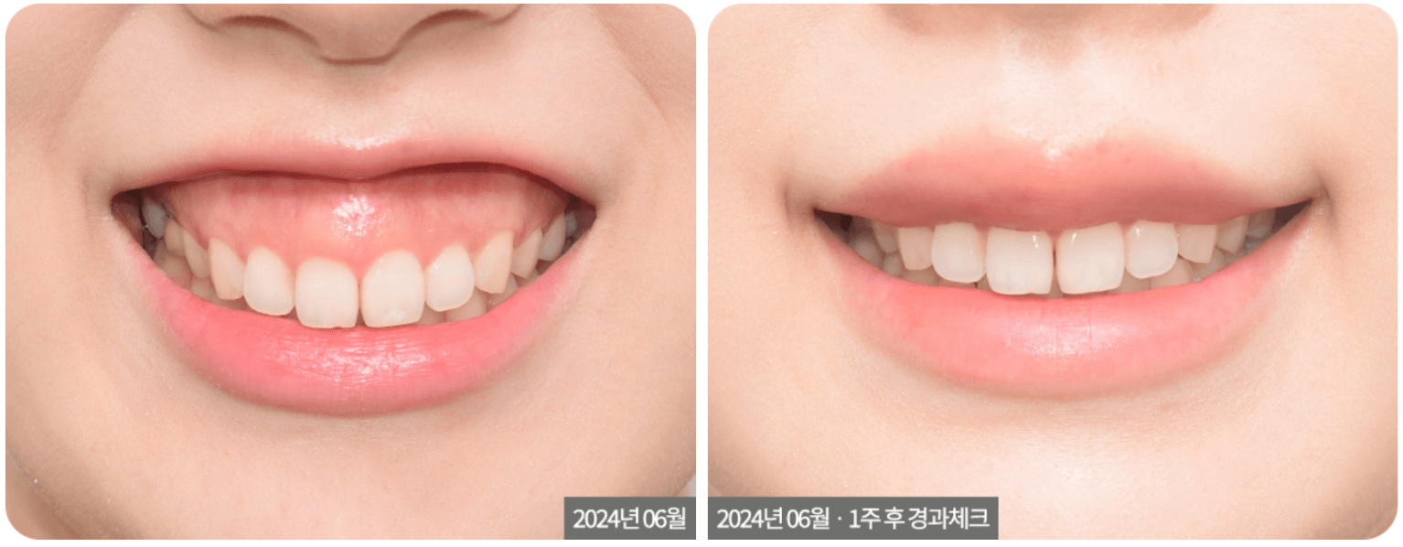 implant