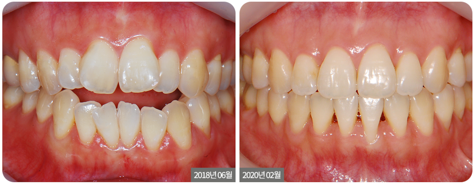  Open Bite Orthodontic Treatment