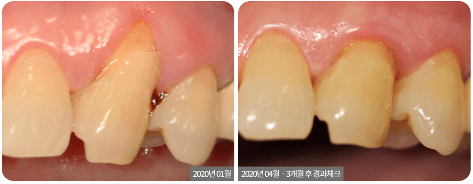 Gum Grafting (Pinhole Surgery)