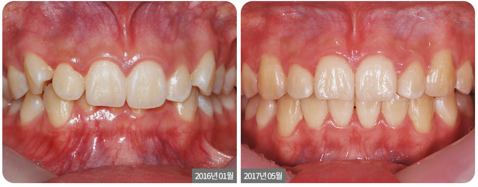 Deep Bite Orthodontic Treatment