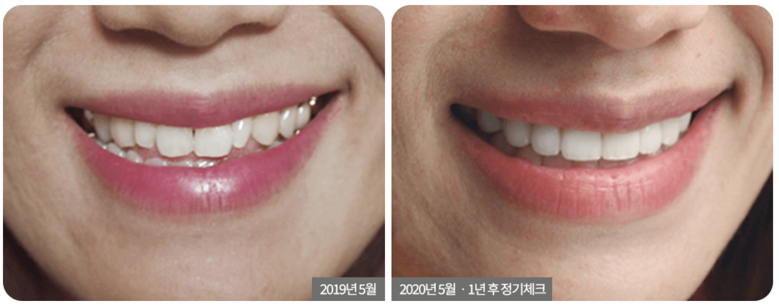 No-Prep Veneers